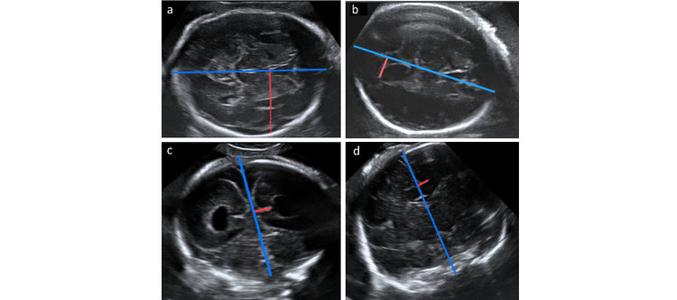 La dilatación ventricular puede estar relacionada con cambios en el desarrollo cortical en los fetos con ventriculomegalia aislada