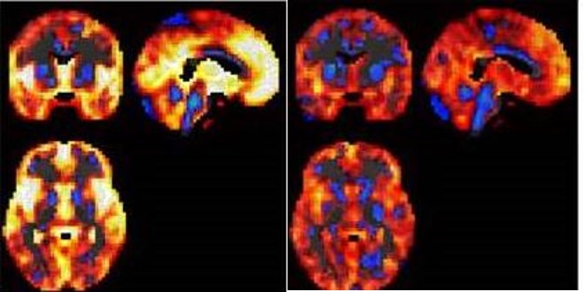 La combinación de neuroimagen y aprendizaje automático, nuevas vías para el diagnóstico del  trastorno bipolar