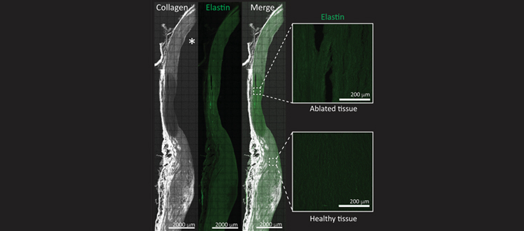 Parámetros de ablación seguros y eficaces desde la raíz de grandes vasos cardíacos