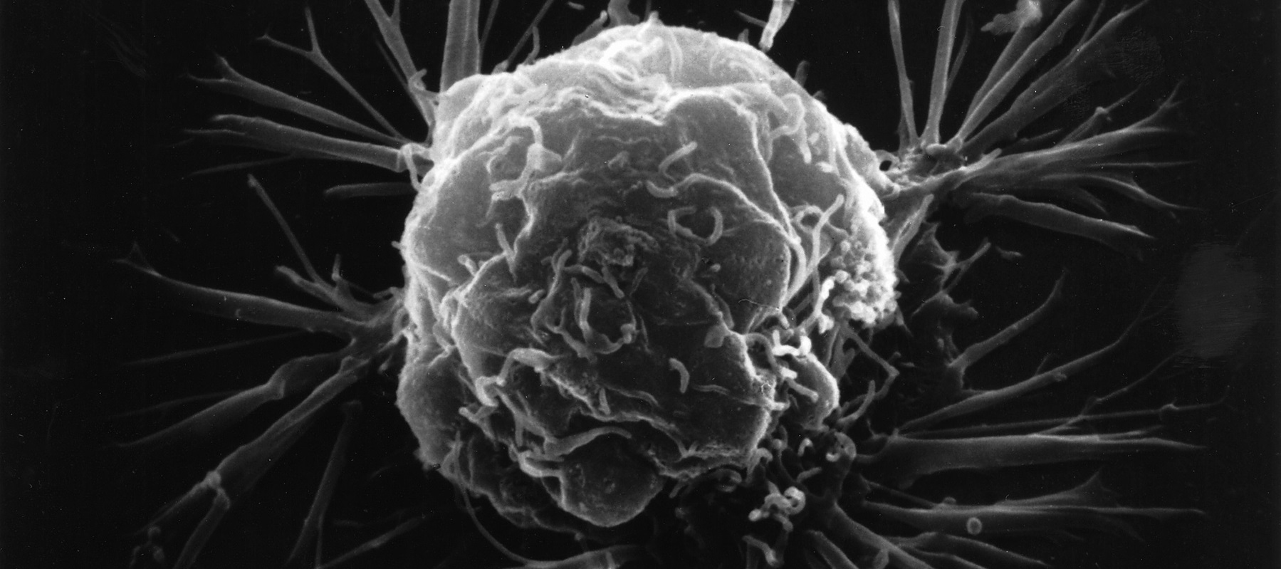 Investigan la calidad de vida percibida por las mujeres recién diagnosticadas de cáncer de mama