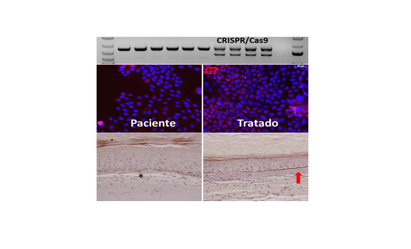 Mejoran la eficacia y precisión de la edición genómica para el tratamiento de la epidermolisis bullosa
