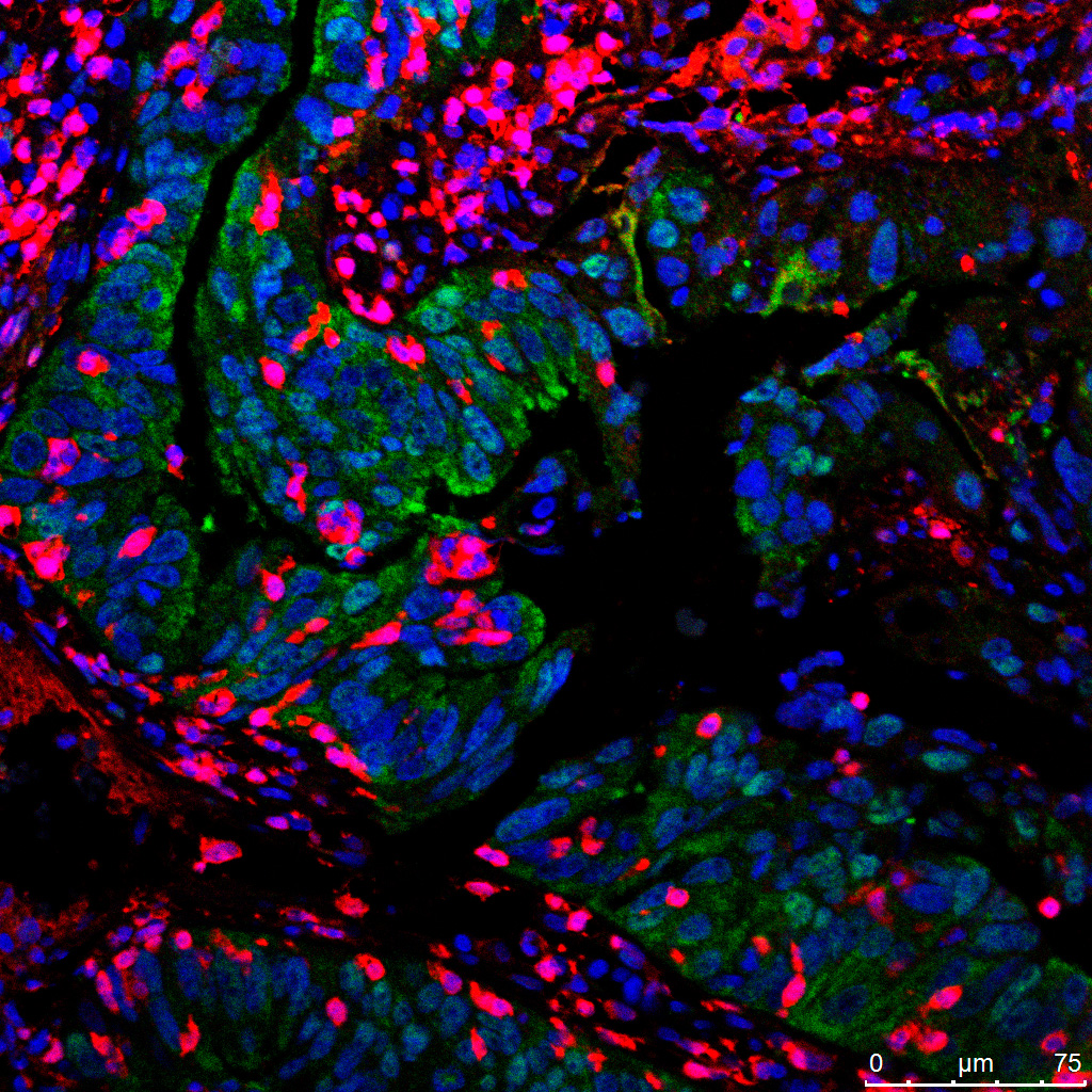 Descubren un conjunto de marcadores de mal pronóstico en pacientes con cáncer de colon y recto
