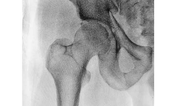 Un ensayo confirma que es seguro adelantar la cirugía de cadera en pacientes antiagregados