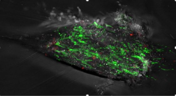 Deleciones en el ADN mitocondrial predicen el Parkinson antes de la aparición de los síntomas