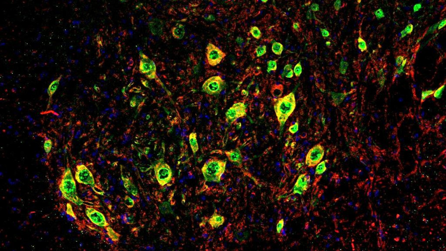 La FDA concede la designación de medicamento huérfano a una terapia génica para la ELA