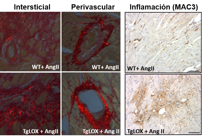 La enzima lisil oxidasa altera la función diastólica y contribuye a la hipertrofia cardíaca